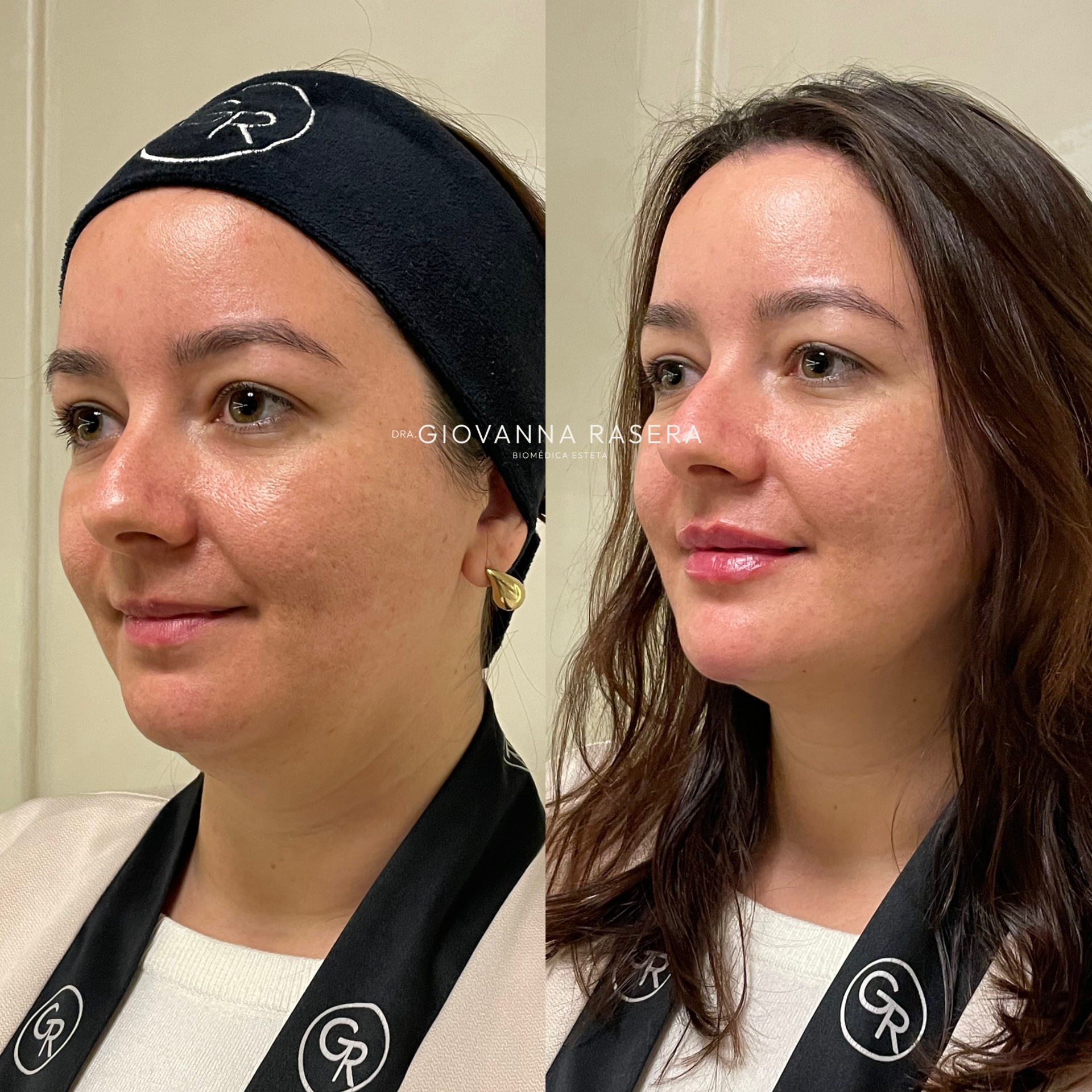 Antes e depois harmonização facial 5