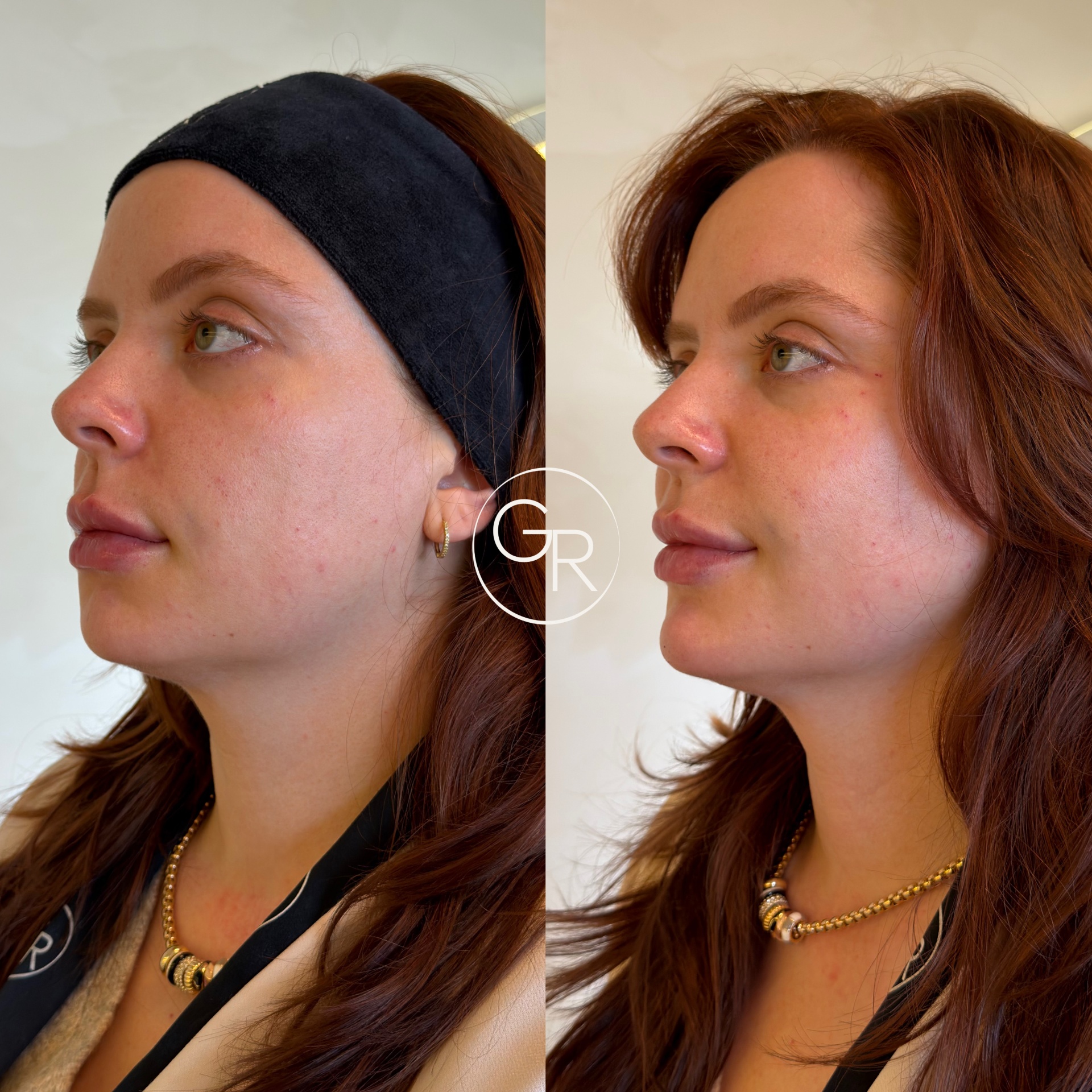 Antes e depois harmonização facial 6