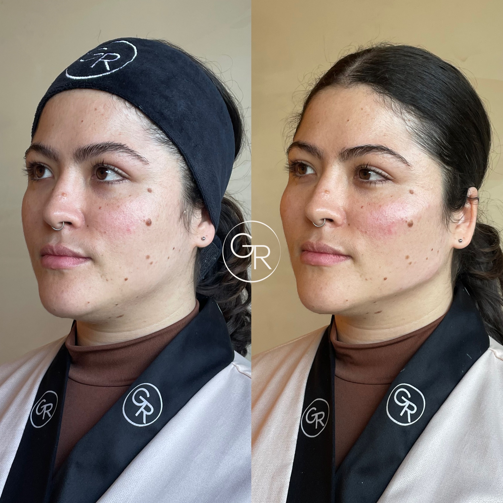 Antes e depois harmonização facial 1