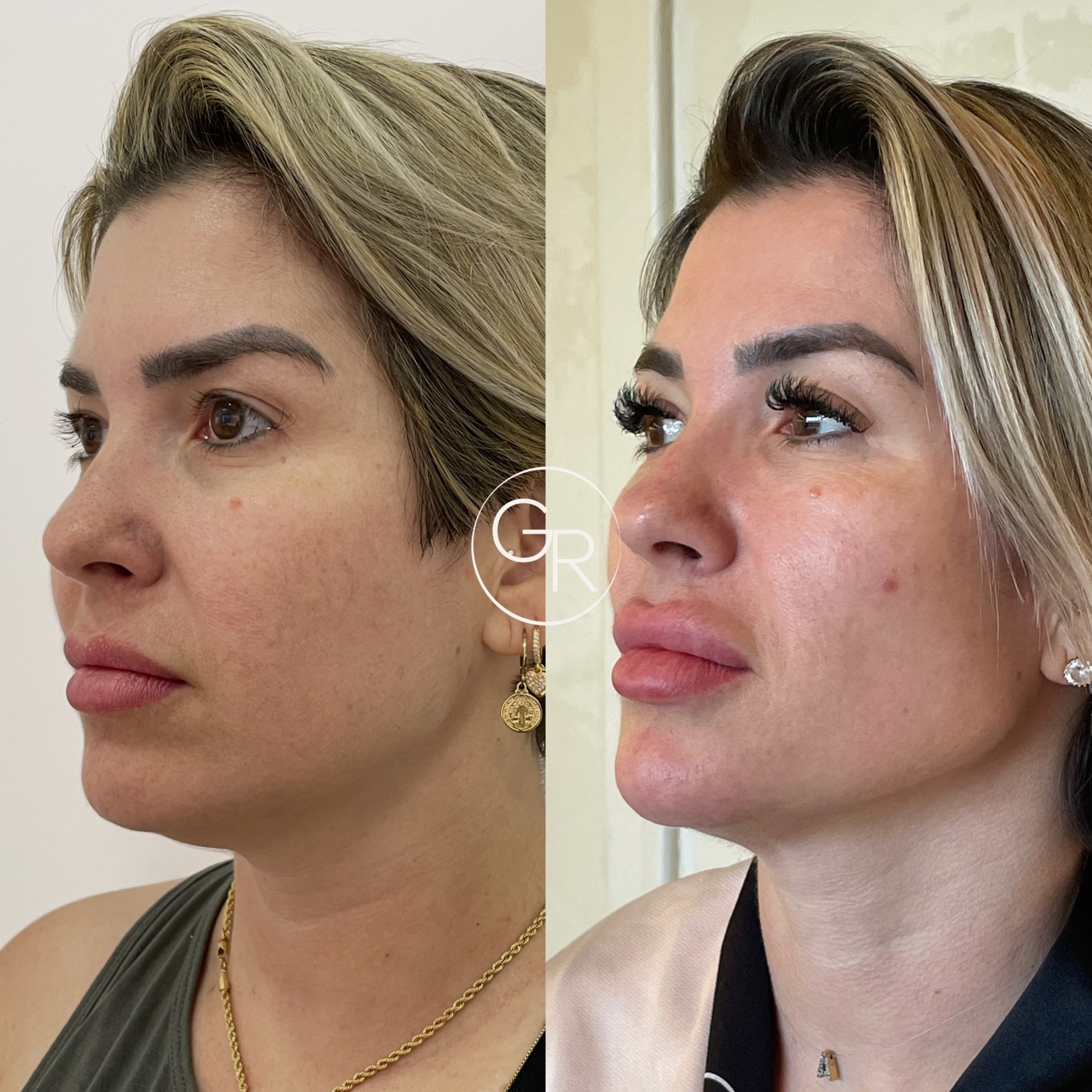 Antes e depois harmonização facial 2
