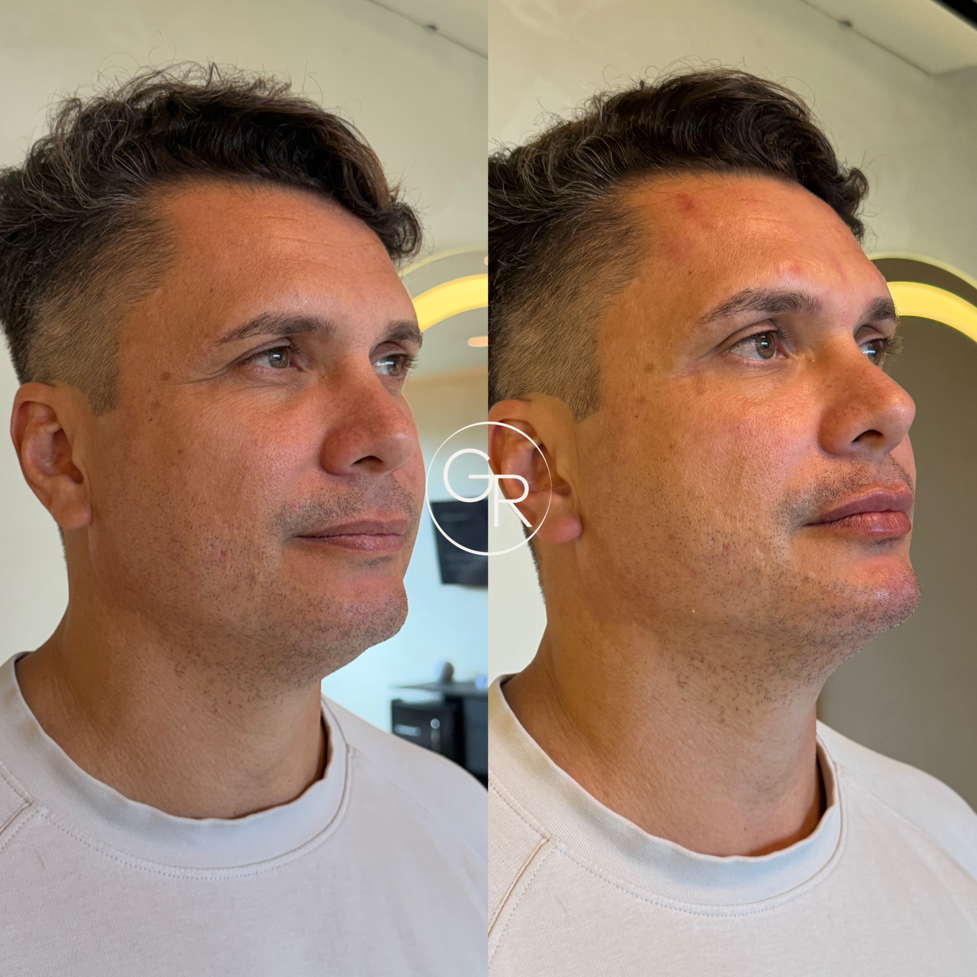 Antes e depois harmonização facial 3