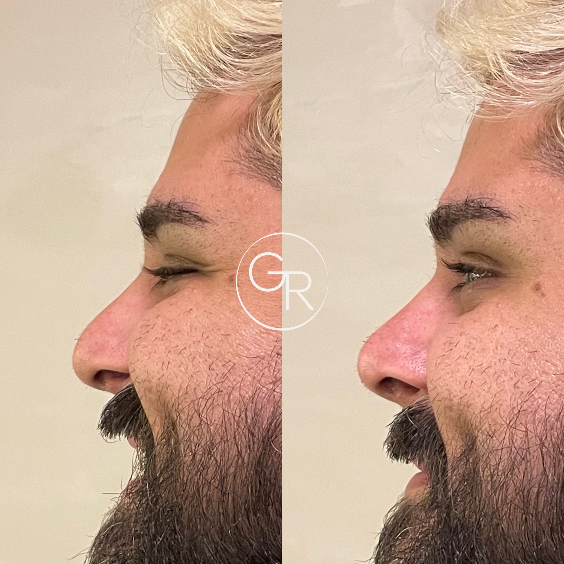Antes e depois harmonização facial 4